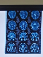 13*17 Лазерные синие таблетки | Новый x -ray | CTCR Film | Medical New Dry Film | Medical Film Laser