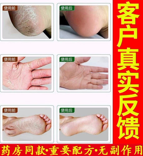 Мазь против сухости, пилинг, против трещин, против зуда