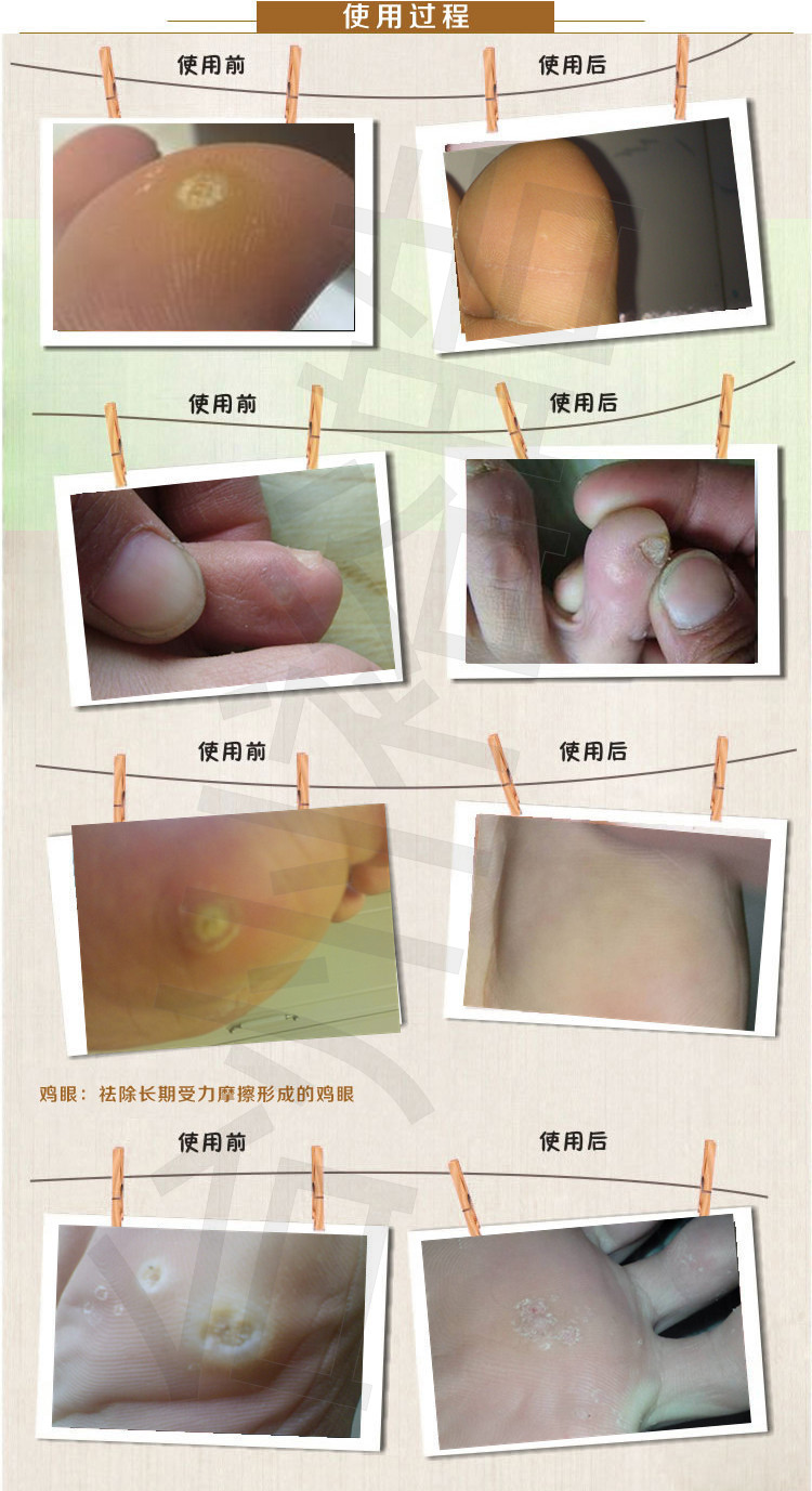 雞眼貼雞眼工具處理盒足部護理速賣通跨境電商貨源