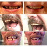 Мгновенная улыбка Темпери Зуб набор Временная зубная косметическая косметическая музыка Стоматологическая симуляция