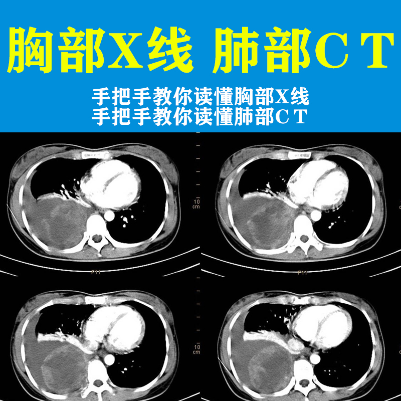 图片[1]-手把手教你读懂肺部ct胸部x线临床公开课医学影像学诊断视频课程-百度网盘下载